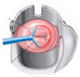 Cirurgia de alta frequência